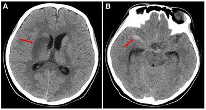 Abiotrophia defectiva causing infective endocarditis with brain infarction and subarachnoid hemorrhage: a case report